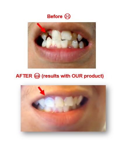 Teeth Repair Kit, Temporary Teeth replacement kit, Saudi Arabia